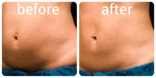 My Experience with CoolSculpting